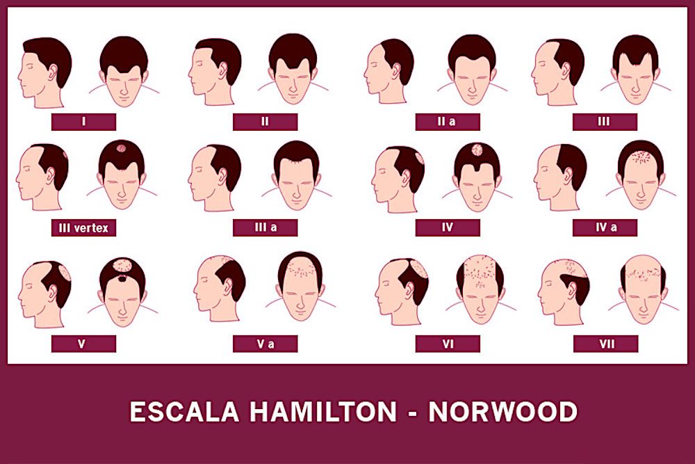 escala Hamilton-Norwood