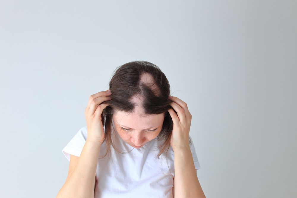 Causas de alopecia difusa